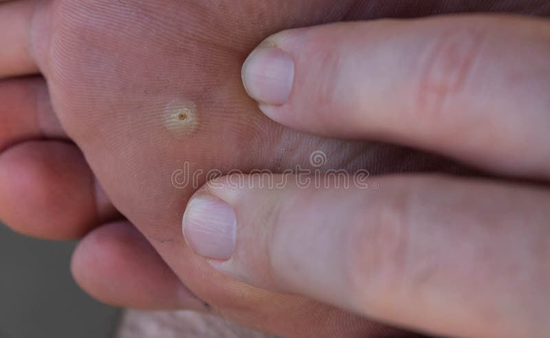 Close up shot of a warty Caucasian man`s foot.