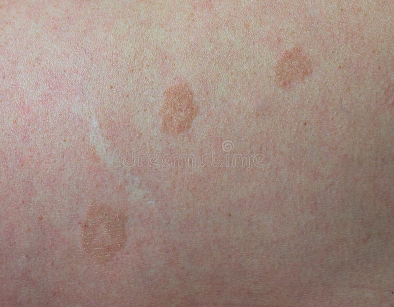 Close Up Skin Disease Tinea Versicolor/Pityriasis Versicolor Stock