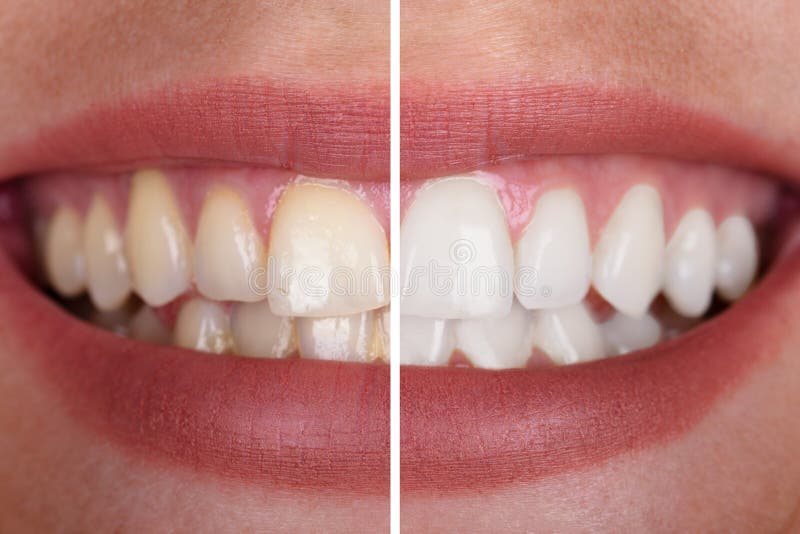 Close-up Of A Smiling Woman`s Teeth Before And After Whitening