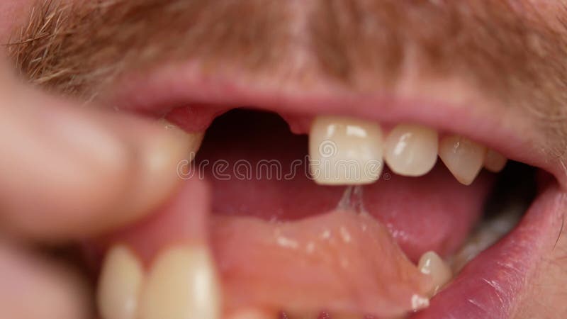 Close-up of teeth. A man shows his denture on two teeth. There are not enough two teeth, instead of them a plastic