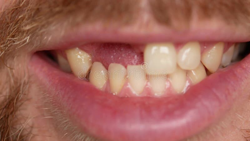 Close-up of teeth. A man shows his denture on two teeth. There are not enough two teeth, instead of them a plastic