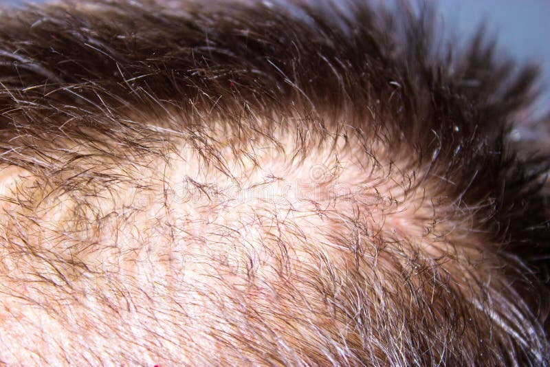 Close-up To Circular Hair Loss at the Back of the Head, Skin Dis Stock Photo - Image of thinning, alopecia: 129019656 Close-up To Circular Hair Loss at the Back of the Head, Skin Dis Stock Photo - Image of thinning, alopecia: 129019656