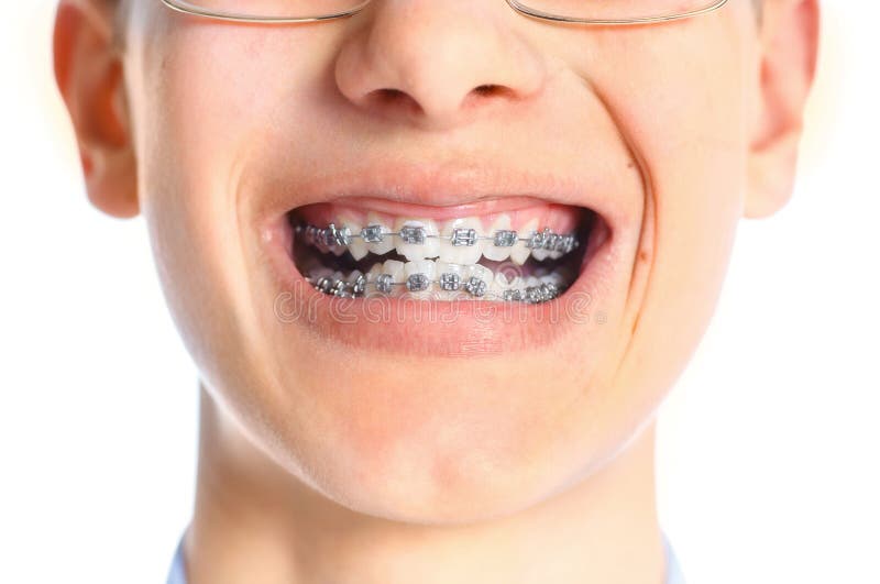 Closeup of Tooth with Braces. Stock Photo Image of cheerful, fair