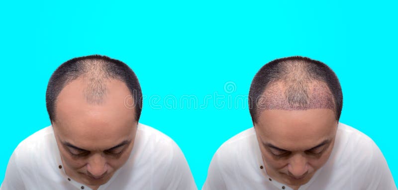 Close Up Top View of a Man`s Head with Hair Transplant Surgery with a  Receding Hair Line. before and after Bald Head of a Man Stock Photo - Image  of middle, hairline: