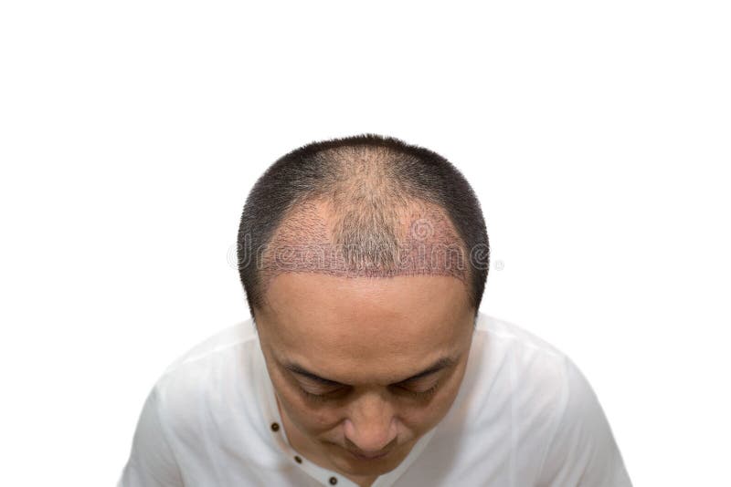 Close Up Top View of a Man`s Head with Hair Transplant Surgery with a  Receding Hair Line Stock Image - Image of hairstyle, baldness: 213889983
