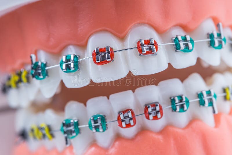 Close-up van orthodontische modelkaken en tanden met steunen stock foto Close-up van orthodontische modelkaken en tanden met steunen stock foto