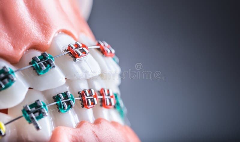 Close-up van orthodontische modelkaken en tanden met steunen stock fotografie Close-up van orthodontische modelkaken en tanden met steunen stock fotografie