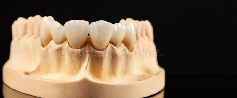Closeup View of Dental Layout of Upper Veneers of Teeth Prothesis