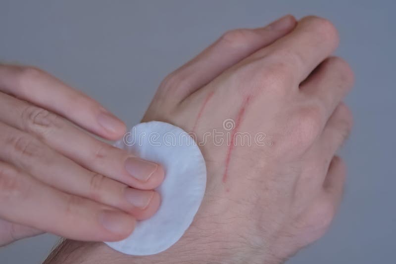 Man trying to treat cat scratches with cotton pad and hydrogen peroxide