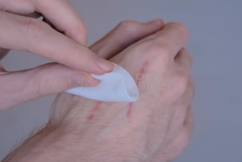 Man trying to treat cat scratches with cotton pad and hydrogen peroxide