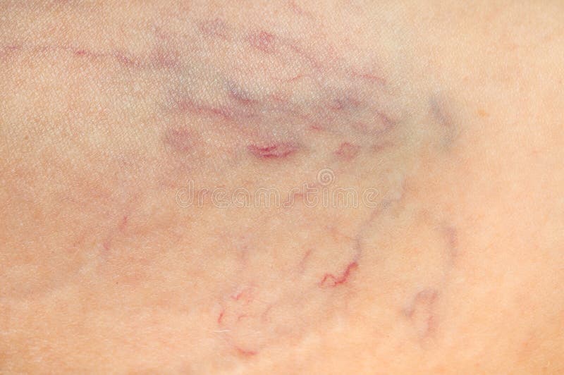 Close-up view of spider veins on female leg