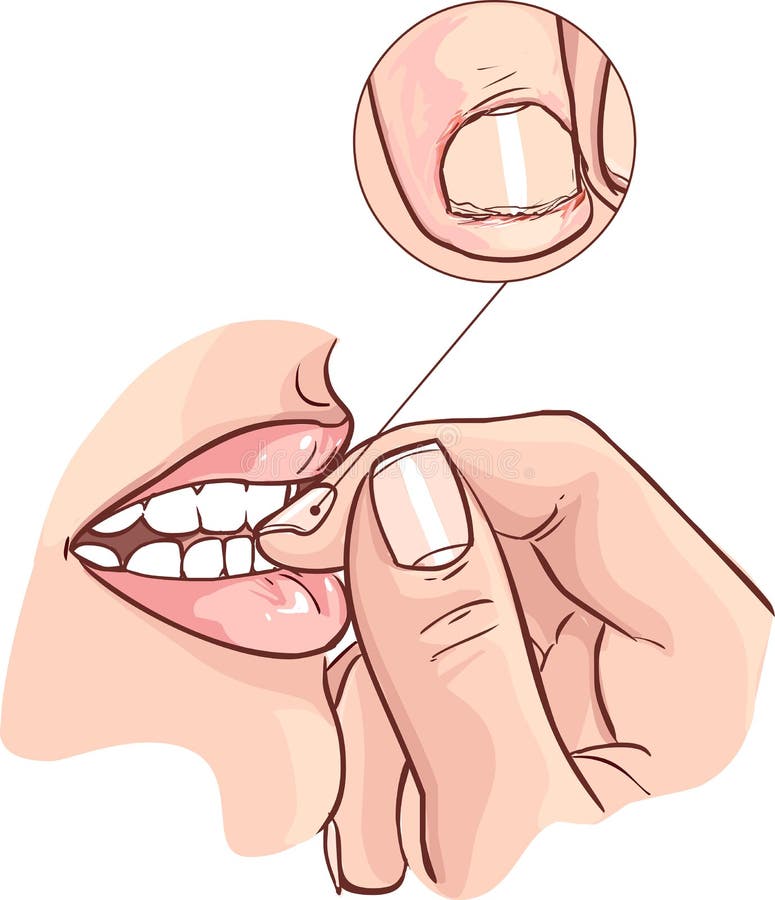 How A Nail Biting Habit Affects Teeth - McSurdy Orthodontics