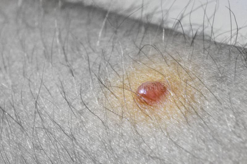 Close-up Wart on a Hairy Human Body, Front and Background Blurred with  Bokeh Effect Stock Image - Image of macro, ageing: 168515361