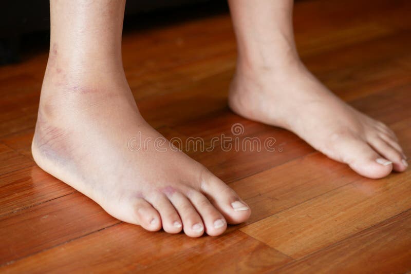 Close Up of Women Feet with Swelling Stock Photo Image of medicine