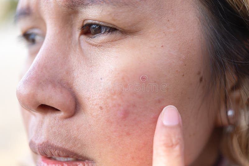 Close up of women freckle, dark spot on face, dried skin issues, need treatment. Asian middle age women