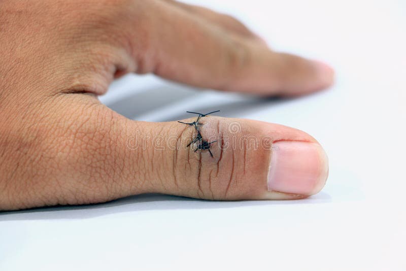 Close-up of wounded and stitched on thumb finger. stock photography Close-up of wounded and stitched on thumb finger. stock photography