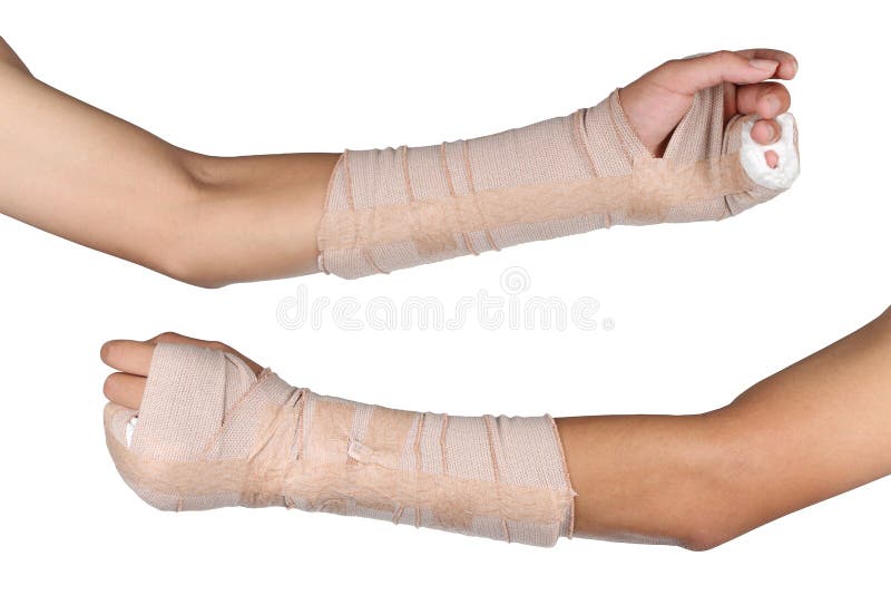 Close up of young Asian boy with arm plaster fiberglass cast covering the wrist finger and arm. stock photos Close up of young Asian boy with arm plaster fiberglass cast covering the wrist finger and arm. stock photos