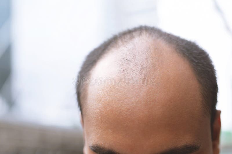 Close Up Young Man Concerned with Serious Hair Loss. Bald Head Thin and Scalp and Broken Hair. Concept Healthcare Stock Image - Image of background, glabrous: 158569317 Close Up Young Man Concerned with Serious Hair Loss. Bald Head Thin and Scalp and Broken Hair. Concept Healthcare Stock Image - Image of background, glabrous: 158569317