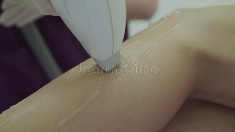 Close view of hair removal laser is used on female legs in beauty clinic