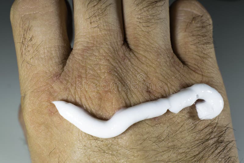 Close View of Dry and Cracked Hand Knuckles, Skin Problem Stock Image