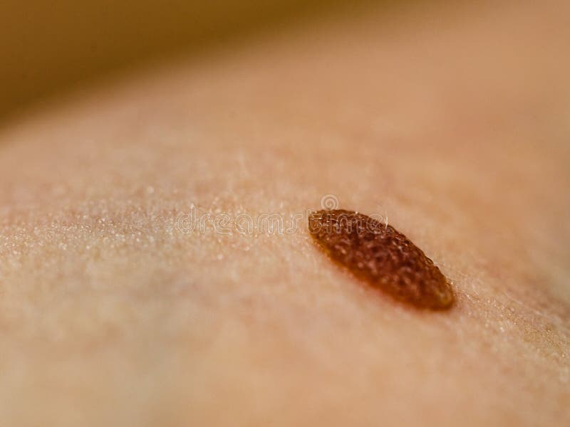 Closeup Brown Mole On Skin Stock Photo Image Of Spot 177635108