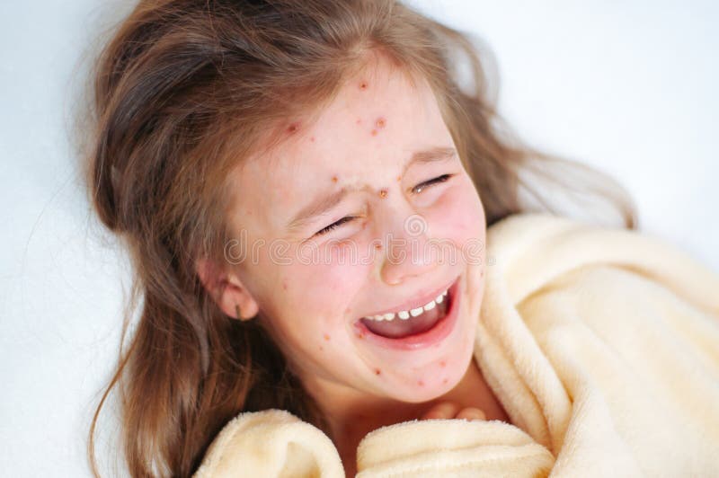 Closeup of cute sad crying little girl in bed. Varicella virus or Chickenpox bubble rash on child stock photos Closeup of cute sad crying little girl in bed. Varicella virus or Chickenpox bubble rash on child stock photos