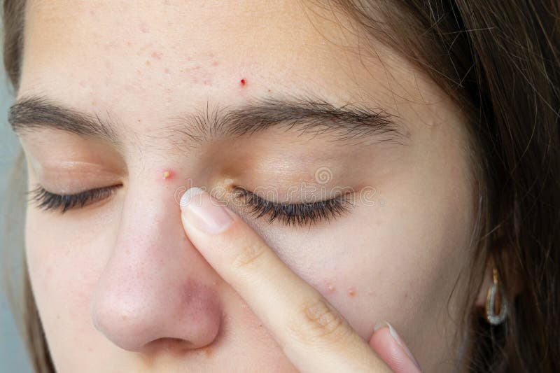 Closeup d'acné sur la peau de l'adolescent. image de closeup d'une jeune femme touchant son visage avec des boutons d'acné visible photos stock