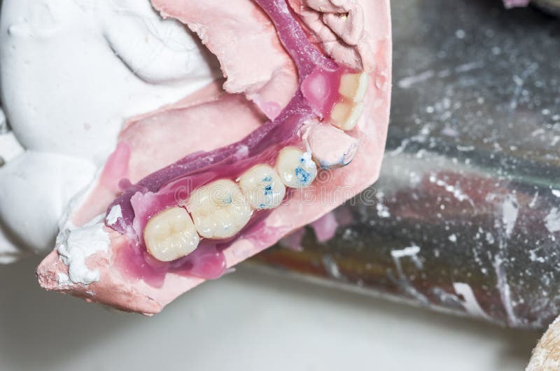 Closeup of Dental Technician is Working with Wax in Dental Mold Stock