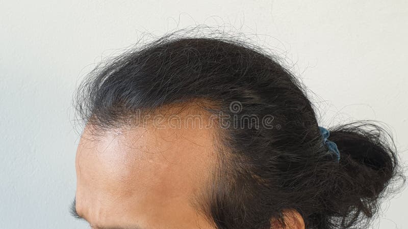 Head Lose Up of Head Asian Man less Hair Stock Photo - Image of hygiene, checking: 136556612 Head Lose Up of Head Asian Man less Hair Stock Photo - Image of hygiene, checking: 136556612