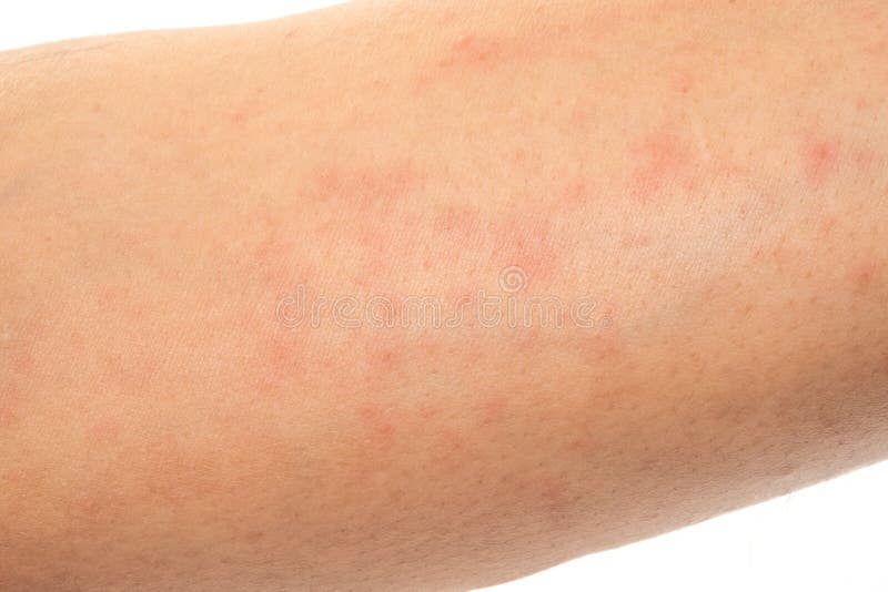 Closeup Image Of A Male Body Suffering From Chronic Skin Rash Food