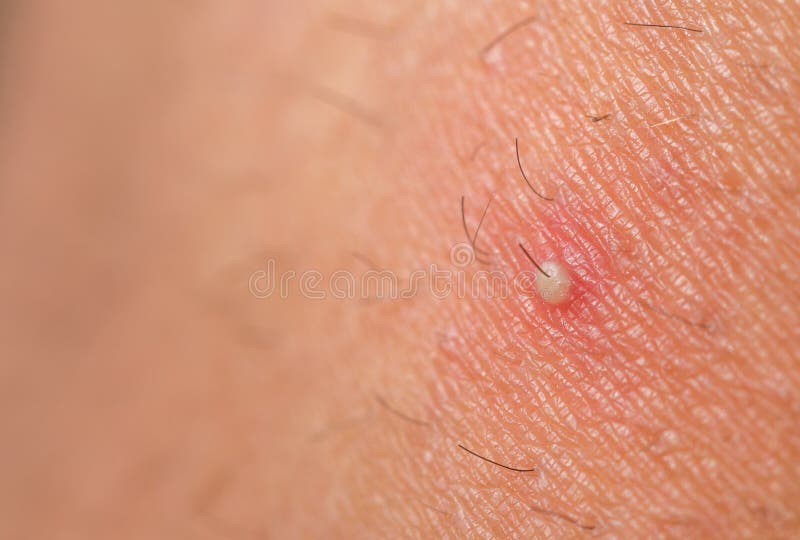 Closeup Ingrown Hair Stock Photos - Free & Royalty-Free Stock Photos from Dreamstime Closeup Ingrown Hair Stock Photos - Free & Royalty-Free Stock Photos from Dreamstime