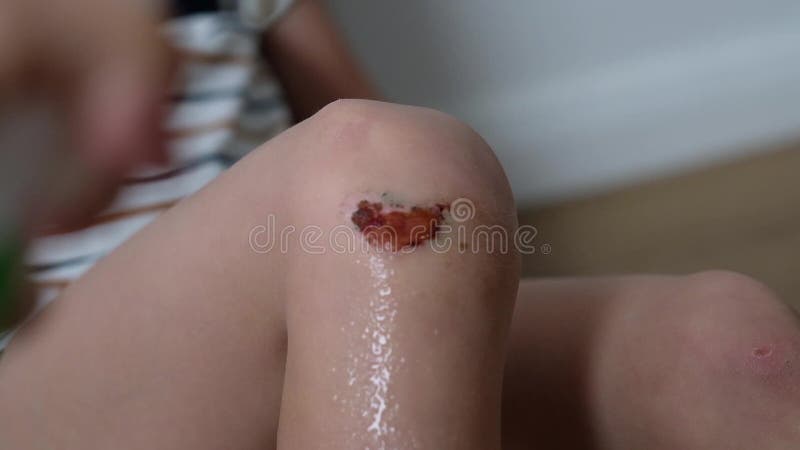 Closeup of injured young kid`s knee. Somebody spray antiseptoc to abrasion