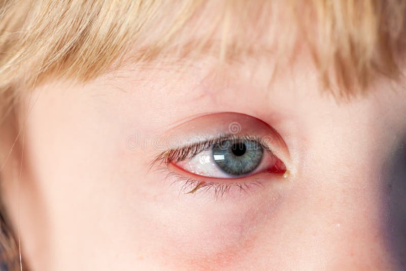 Closeup of Irritated Red Bloodshot Eye Conjunctivitis Stock Photo