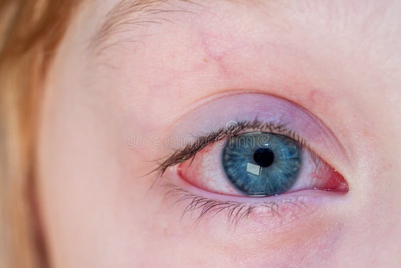 Closeup of Irritated Red Bloodshot Eye Conjunctivitis Stock Photo