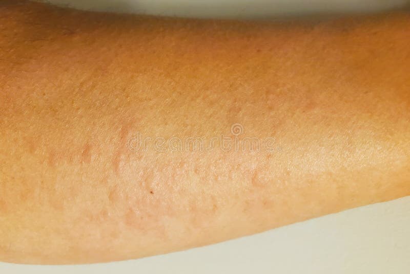 Closeup of an Itchy Arm Flaring with Hives Stock Photo Image of