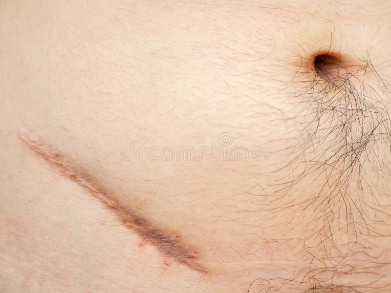 normal appendicitis scar