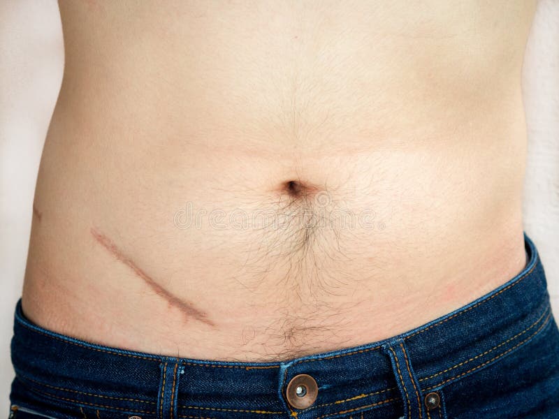Closeup of man showing the stomach with a scar from appendicitis surgery.