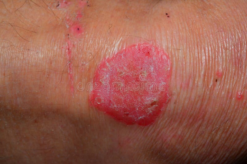 Closeup Of Psoriasis On Knee Stock Photo Image Of Dermatology