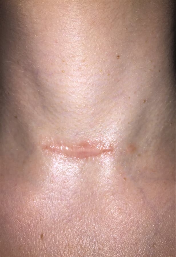 Scar Photos - Thyroid Cancer Surgery, Thyroidectomy - Endocrine Surgery |  UCLA Health