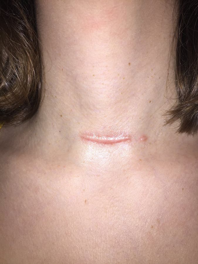 Raised hypertrophic scar on neck after thyroidectomy. 