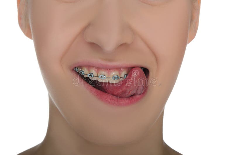 Closeup of Smiling Mouth with Braces Stock Photo Image of teen, mouth