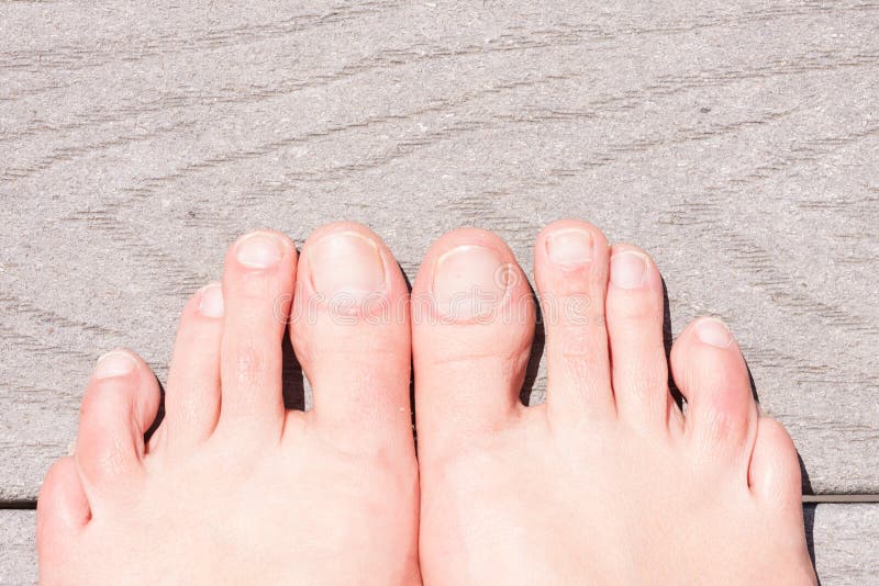 Closeup of ugly woman's feet. 