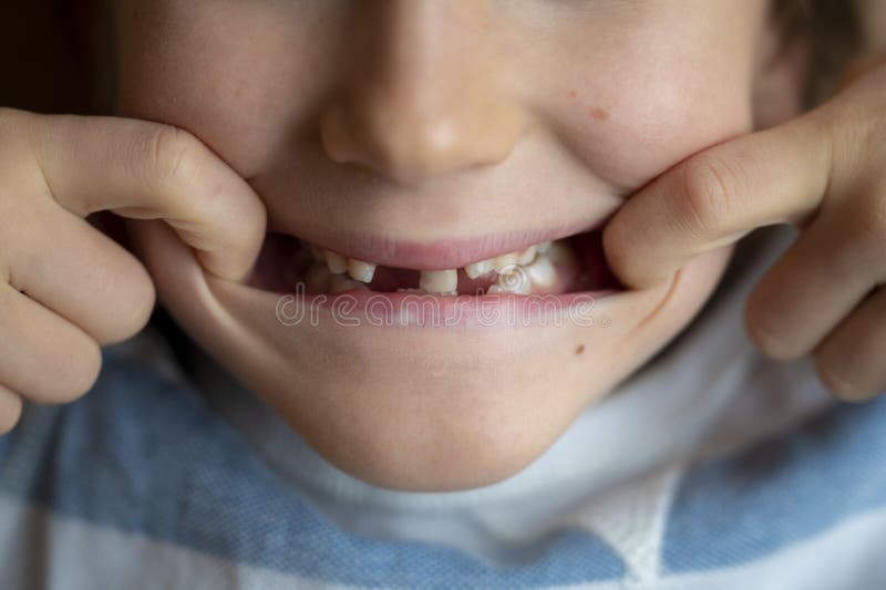 Closeup View Of A Toddler Boy Showing His Missing Milk Teeth Stock