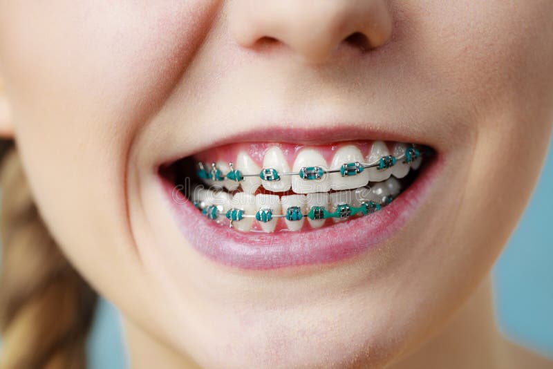 Dentist and orthodontist concept. Closeup of woman showing teeth with blue braces, making funny silly face. Dentist and orthodontist concept. Closeup of woman showing teeth with blue braces, making funny silly face