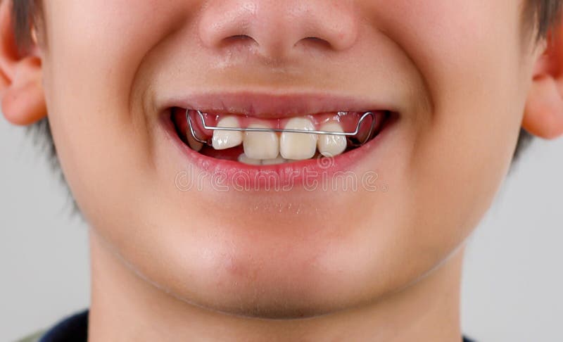 Closeuse adolescent garçon bouche avec la diastéa overmite dents manque espace habillé traitement de l'appareil orthodontique. images libres de droits