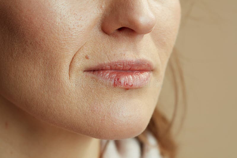 Closeuse sur femme avec herpès sur les lèvres sur fond beige photographie stock