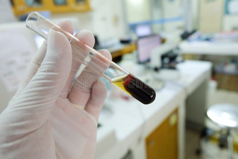 Clotted Blood With Serum In Tes Tube Stock Image Image of female