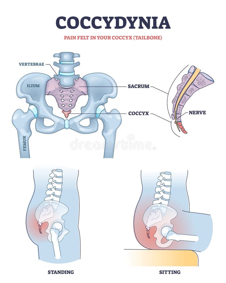 https://thumbs.dreamstime.com/b/coccydynia-as-pain-felt-coccyx-tailbone-anatomical-outline-diagram-coccydynia-as-pain-felt-coccyx-tailbone-anatomical-240051919.jpg