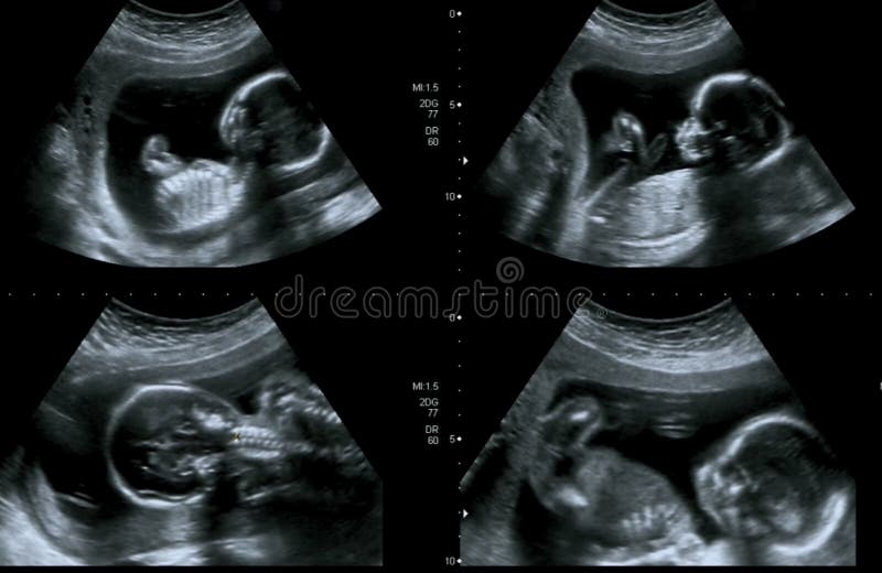 Colagem médica das imagens do ultrassom durante a mostra da gravidez da mulher fotografia de stock royalty free Colagem médica das imagens do ultrassom durante a mostra da gravidez da mulher fotografia de stock royalty free