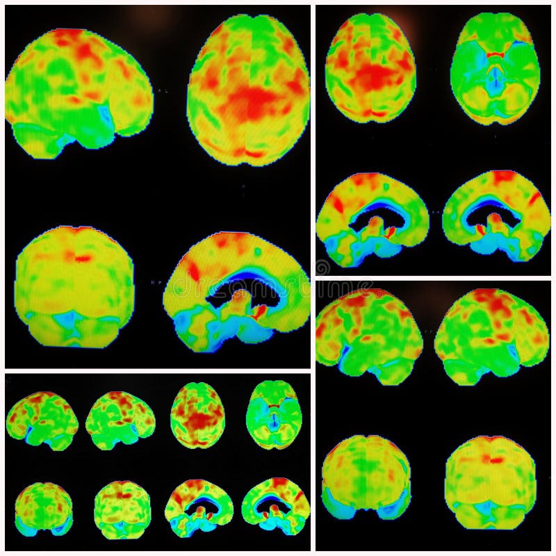 Modern nuclear medicine PET/CT protocols made possible to see different pathology of the brain more clear ,as example this collage with Alzheimer's dementia pattern with superimposed involvement of the occipital lobes , Lewy body dementia. Modern nuclear medicine PET/CT protocols made possible to see different pathology of the brain more clear ,as example this collage with Alzheimer's dementia pattern with superimposed involvement of the occipital lobes , Lewy body dementia.
